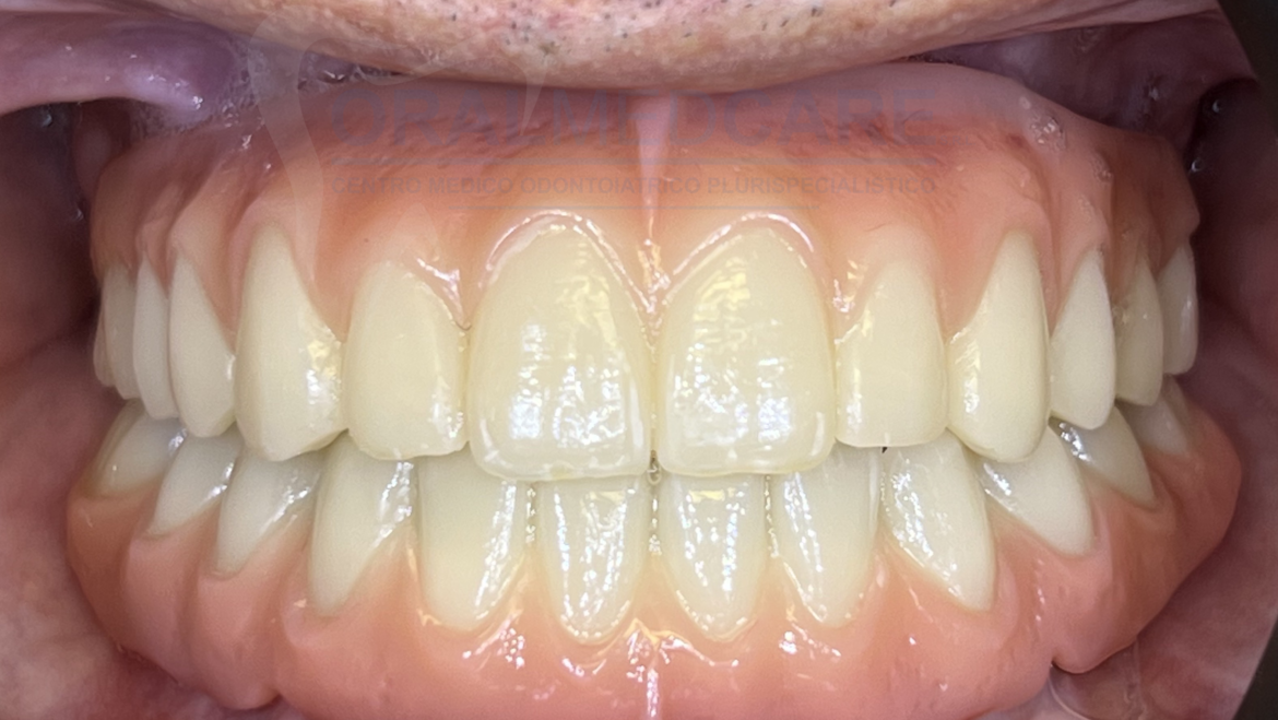 PROTESI IBRIDA FULL ARCH A SUPPORTO IMPLANTARE